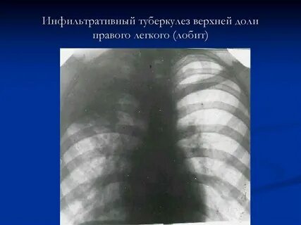 Очаговая инфильтрация левого легкого