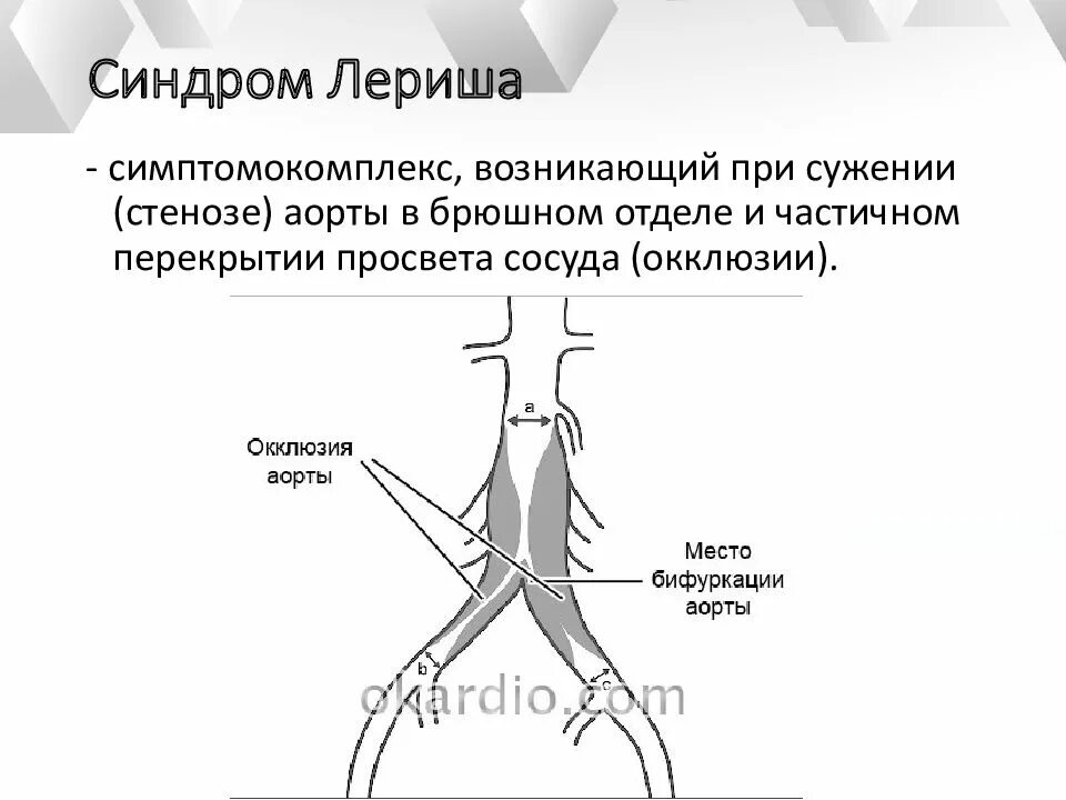 Синдром аорты. Синдром лериша аорто бедренное шунтирование. синдром лериша клинические рекомендации. синдром поражения бифуркации аорты. ангиограмма больного с синдромом лериша..