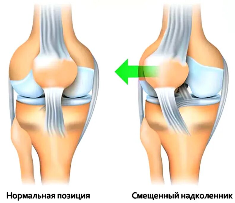 Связка мениска колена. Медиальный удерживатель надколенника нестабильность надколенника. Торсионный вывих надколенника. Вивихнадколенника коленного сустава. Растяжение связки надколенника.