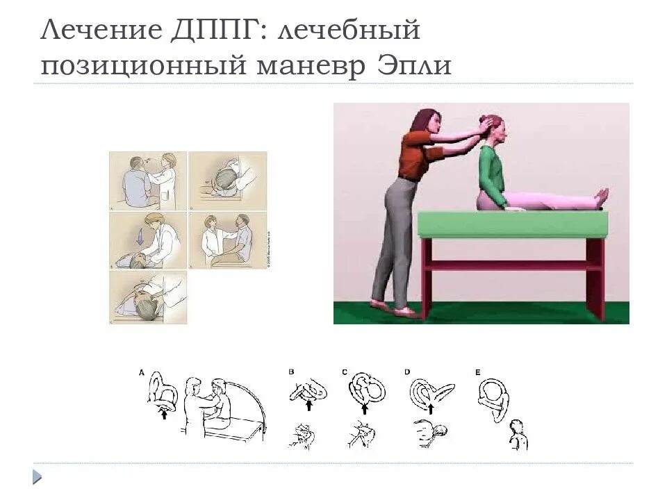 Лечебный позиционный маневр Эпли. Позиционные маневры (Эпли, Семонта, Лемперта и другие)..