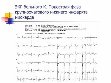 Изменения на экг при инфаркте миокарда