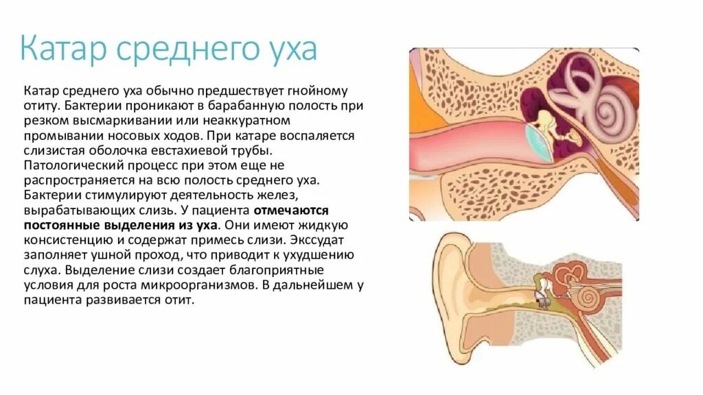 Катаральное воспаление среднего уха.