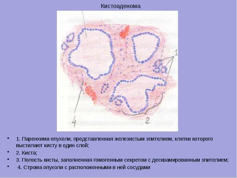 Доброкачественные и злокачественные опухоли молочных желез. Новообразование молочной железы. Филлоидная фиброаденома молочной железы узи. Доброкачественные и злокачественные опухоли молочных желез. Опухоль протоковая молочной железы.