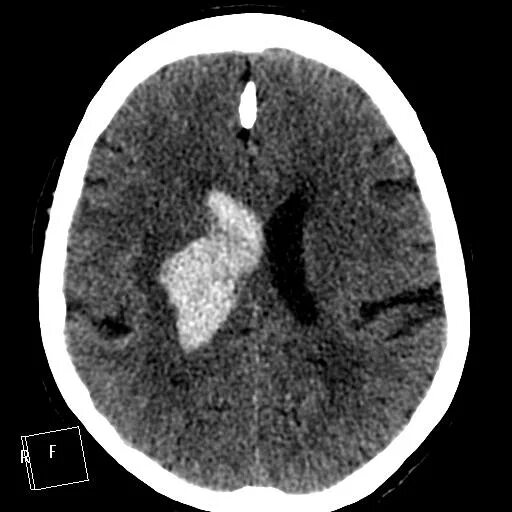 Кт головного мозга кровоизлияние. Кровоизлияние в желудочки головного мозга кт. Внутрижелудочковое кровоизлияние кт. Желудочки головного мозга на кт. Кровоизлияние в желудочки