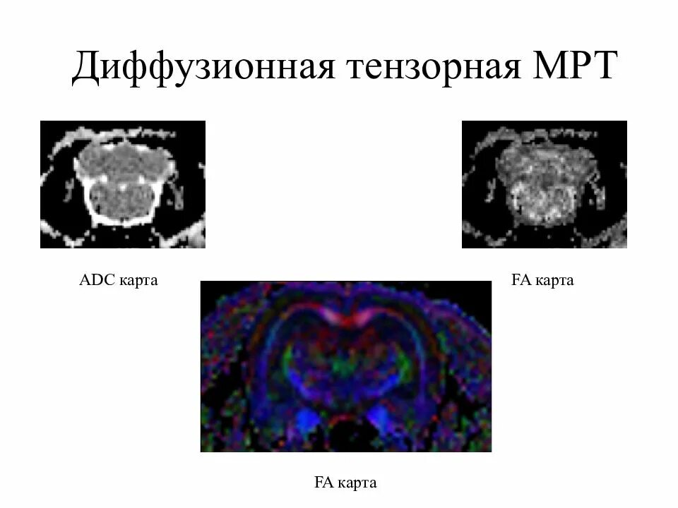 Диффузное мрт. Dwi adc мрт. диффузно тензорное мрт. диффузионная мрт. диффузионно взвешенное изображение мрт.