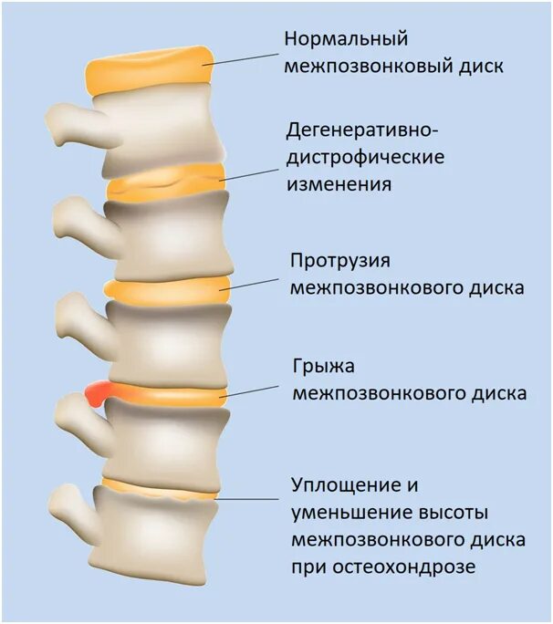 Боли в спине протрузии. Диски позвоночника. Дистрофические изменения межпозвонковых дисков. Дегенеративно дистрофические изменения межпозвоночного диска. Остеохондроз протрузии межпозвонковых дисков.