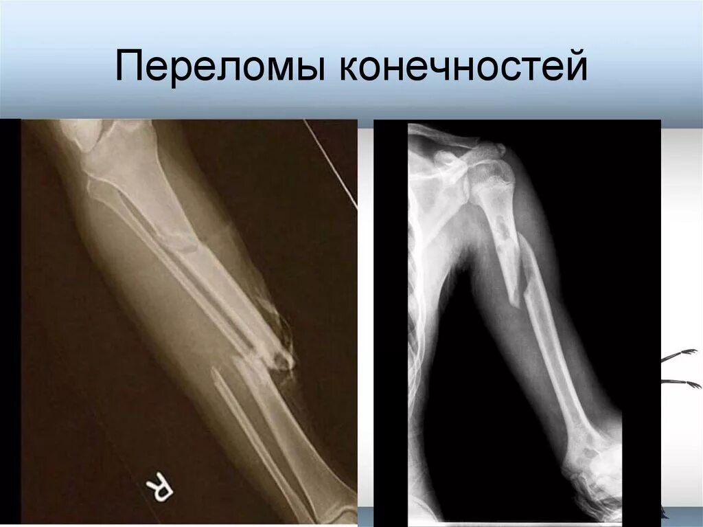 Открытая трещина. Открытые переломы голени. Переломы верхних конечностей презентация.