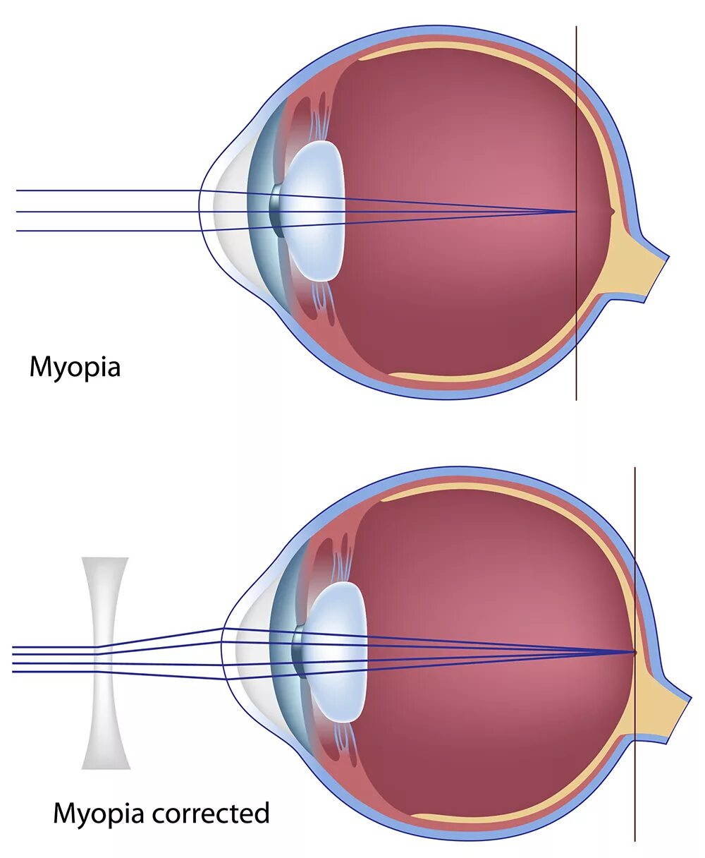 Близорукость. Миопия и здоровый глаз. Глазное яблоко при дальнозоркости. Пресбиопия.
