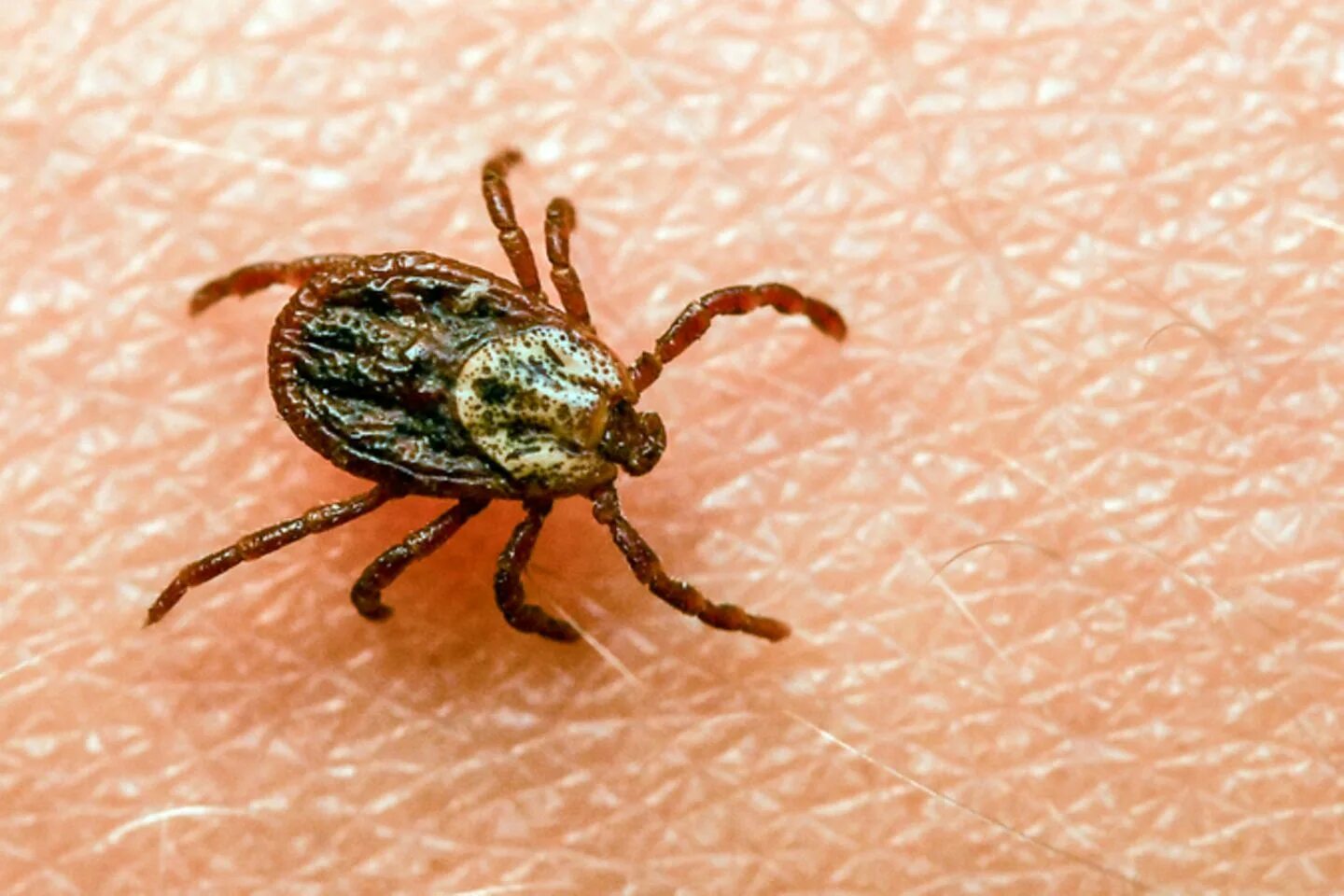 Lyme Disease May Up Risk for Mental Illness, Suicidal Behavior