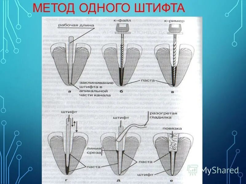 Штифт для пломбирования корневого. Пломбирования корневого канала гуттаперч. Метод одного штифта. Пломбирование методом одного штифта. Метод одного штифта.