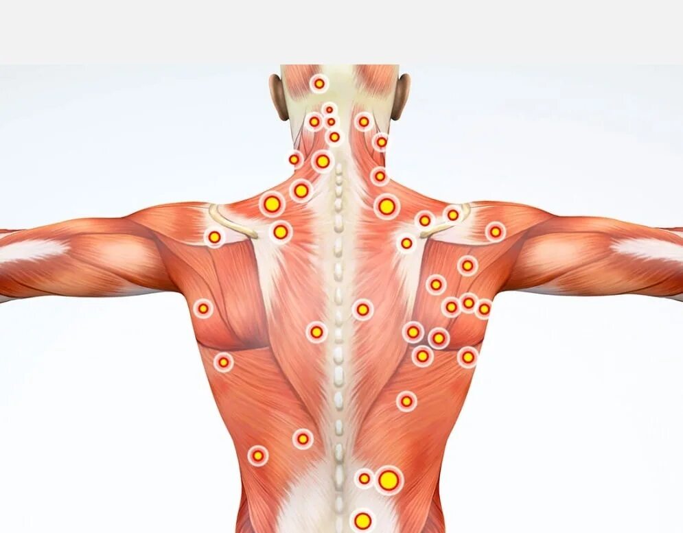 Триггерные точки поясницы. Миофасциальный триггерные точки. Трапециевидная мышца спины триггерные точки. Тт1 триггерная точка. Триггерные точки на спине.