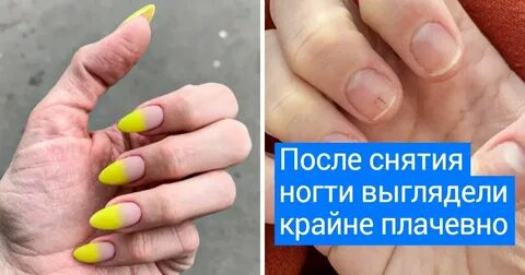 Отслоились ногти от гель