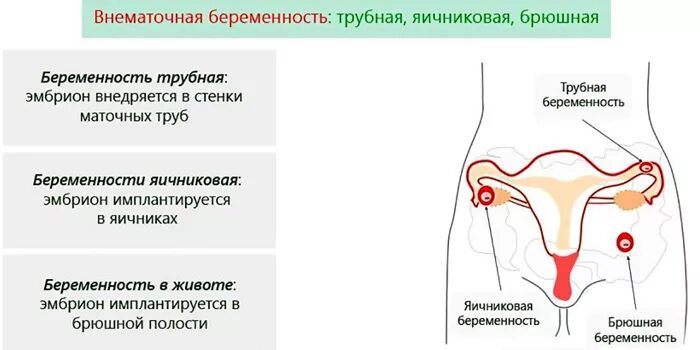 Риск внематочной беременности. Внематочная беременность в брюшной полости. Абдоминальная брюшная беременность что такое. Брюшная беременность фото. Брюшная беременность презентация.