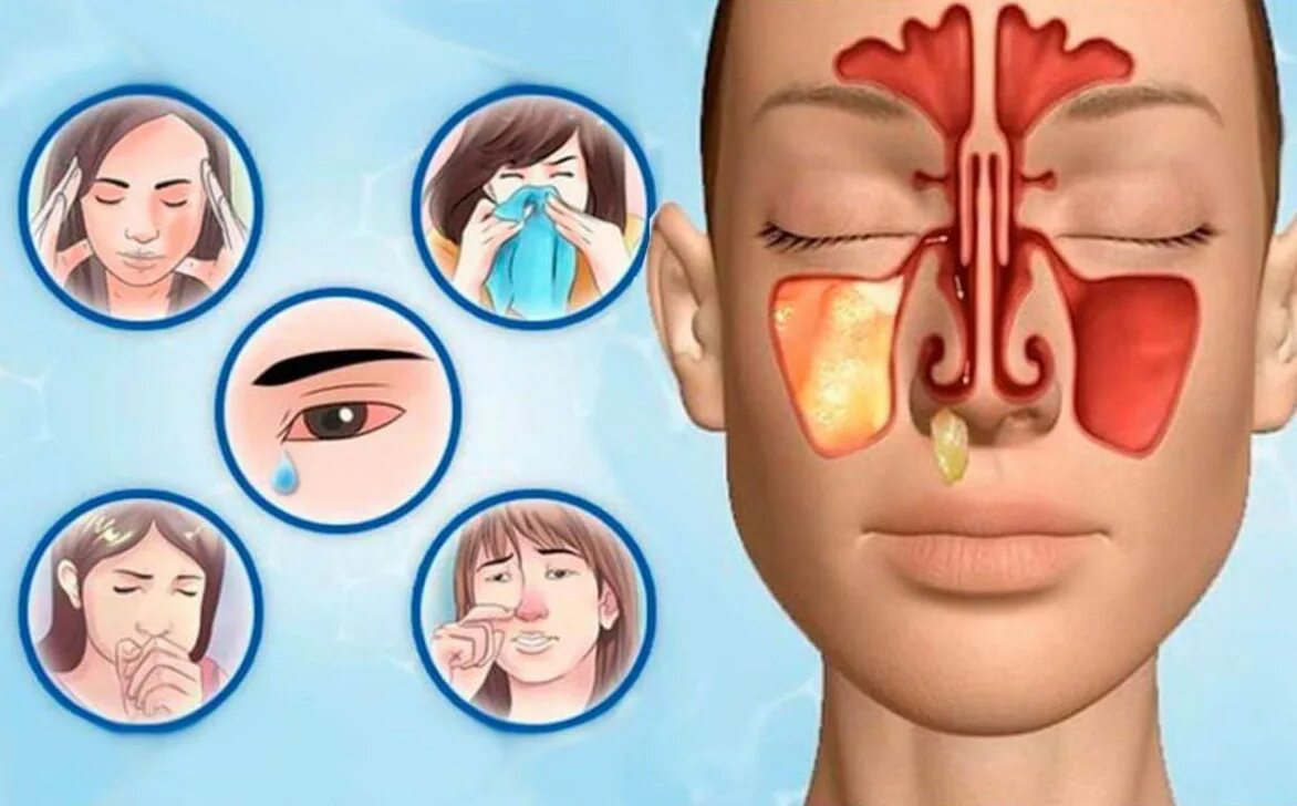 Заложенность носа при орви. Гайморовы пазухи гайморит. Гайморовы пазухи гайморит хронический. Клиника острого одонтогенного синусита.
