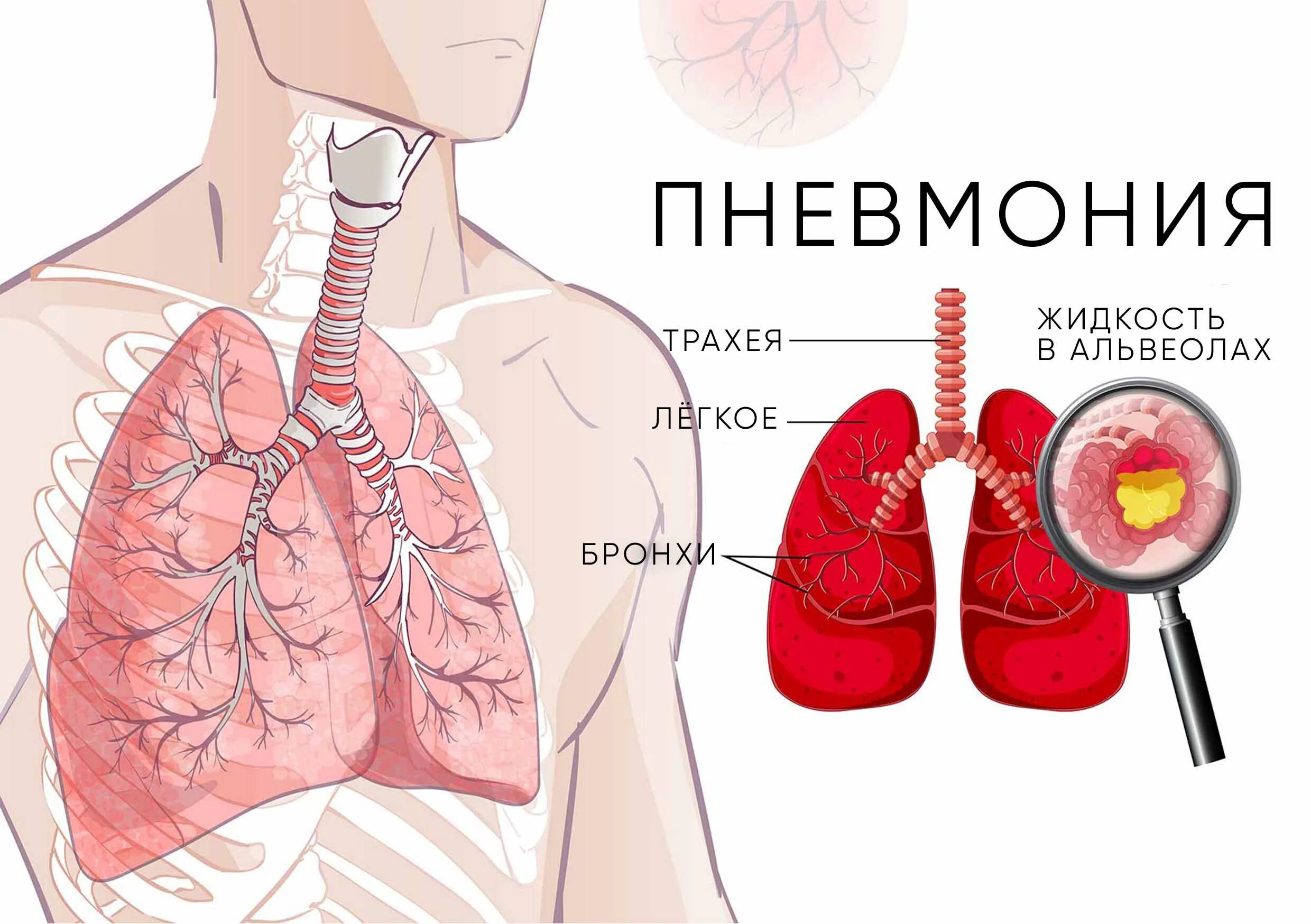 Пневмония легких опасно