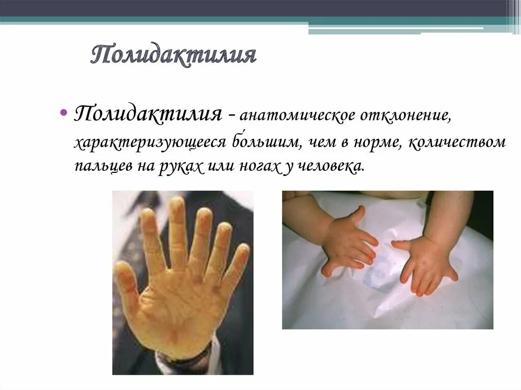 6 пальцев на руках у детей. Полидактилия генное заболевание. Наследование полидактилии. Полидактилия аутосомно доминантное наследование. Полидактилия клинические проявления.