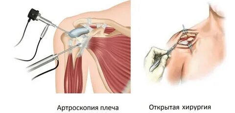 Артроскопия плечевого сустава