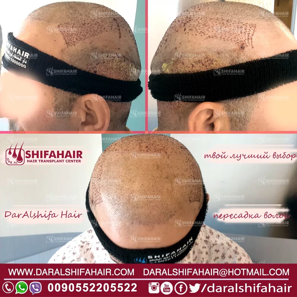 Операция по пересадке волос турция. Трансплантация волос в турции. Пересадка в турции. Пересадки волосы в турцию. Операция по пересадке волос.