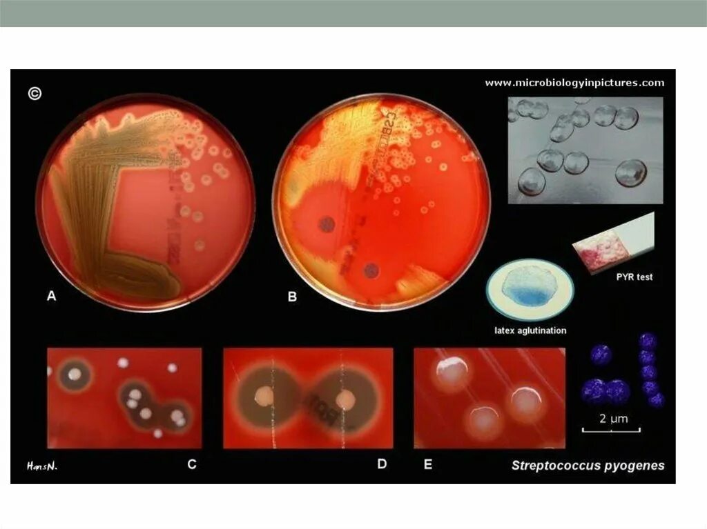 Пневмококк на кровяном агаре. Альфа гемолитический стрептококк. Гемолитический стрептококк колонии. Тест стрептококк группы а