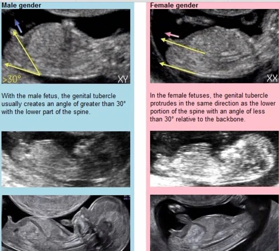 Пол ребенка на УЗИ. УЗИ 12 недель пол ребенка. УЗИ пол ребенка мальчик. Пол ребёнка на 12 неделе. Как отличить на узи