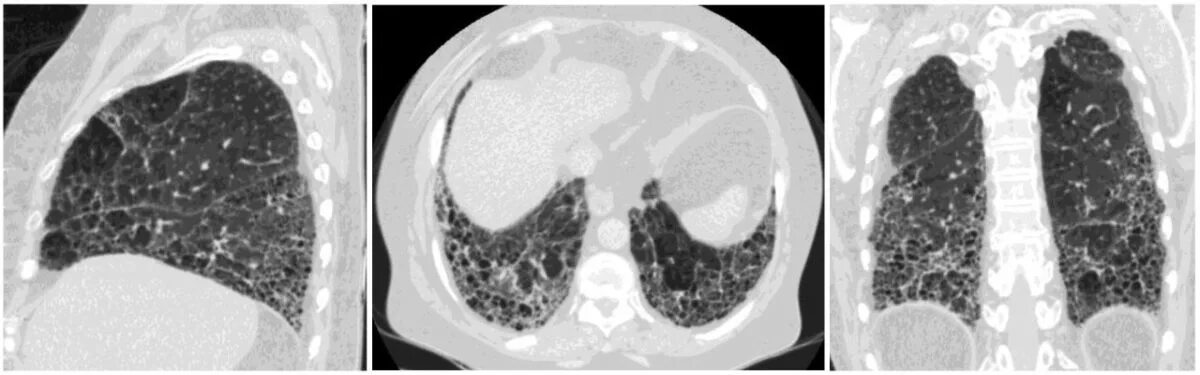 Фиброз легких врач. Идиопатический фиброз легких кт. Диффузный пневмофиброз кт. Фиброзирующий альвеолит на кт. Интерстициальный легочный фиброз кт.