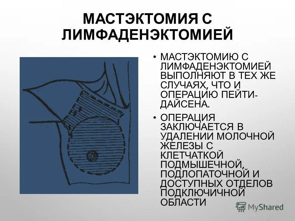 После операции опухоли молочной железы. Радикальная мастэктомия. Радикальная мастэктомия молочной железы. Мастэктомия с лимфаденэктомией. Операция мастэктомия молочной железы.