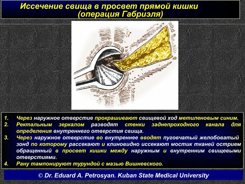 Ректальные железы. Операция иссечение свища прямой кишки. Свищ прямой кишки после операции. Операция по удалению свища прямой.