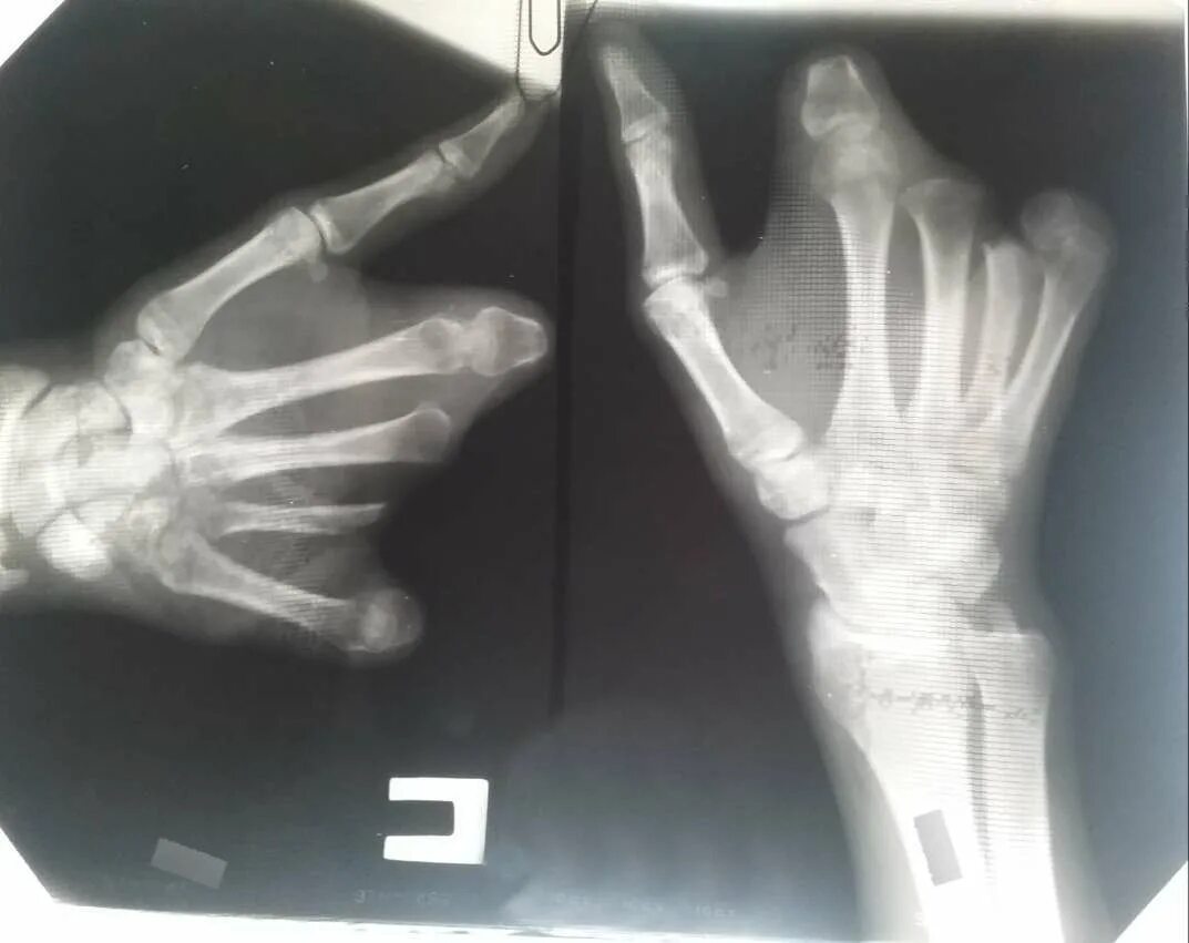 Брахидактилия безымянного пальца. Онемение указательного пальца. Гебердена узелки гебердена. Ладонный апоневроз контрактура дюпюитрена. Инвалидность пальцев руки.