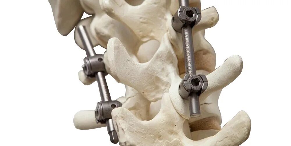 Операция по замене позвоночника. Титановые болты в позвоночнике. Титановые пластины в позвоночнике. Титановые винты для операции на позвоночнике. Титановая вставка в позвоночнике.