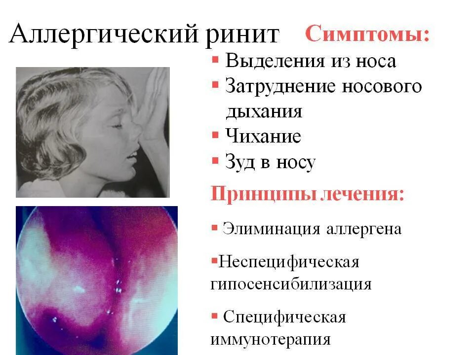 Как лечить ринит у взрослых. Симптомы острого ринита. аллергический ринит симптомы. симптомы аллергического ринита.