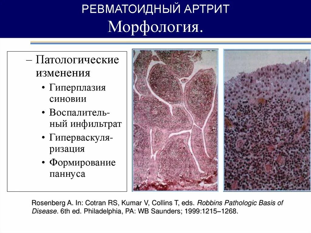 Ревматоидный артрит легких. Патоморфология ревматоидный артрит. Ревматоидный паннус микропрепарат. Паннус ревматоидный артрит патанатомия. Ревматоидный артрит микропрепарат.