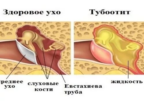 Заложенность уха тубоотит. Евстахиит воспаление слуховой трубы. Тубоотит барабанная перепонка. Воспаление слуховой евстахиевой трубы симптомы.