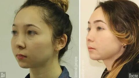 Операция по увеличению челюсти