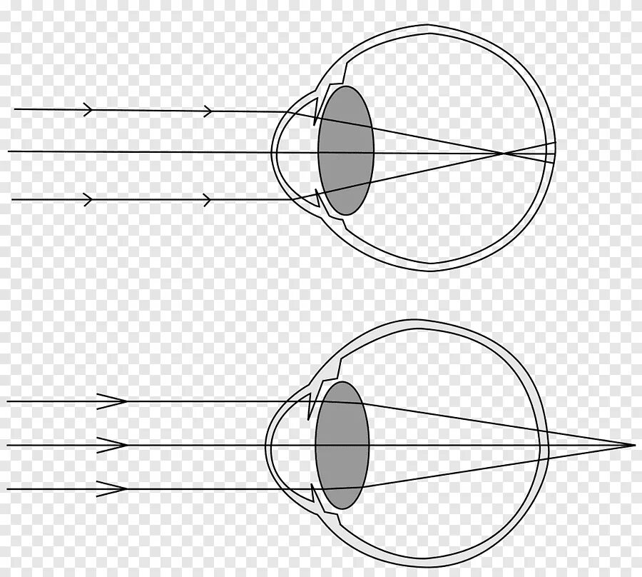 Схема близорукости и дальнозоркости. Миопия схема глаза. Близорукость и дальнозоркость схема глаза. Зрение схема близорукость и дальнозоркость. Лучи света фокусируются за сетчаткой