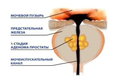 Предстательная железа периуретральные железы
