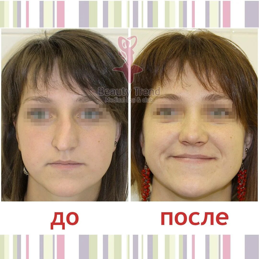Деформация кончика носа. Ринопластика носа искривление перегородки. Септопластика (исправление носовой перегородки). Риносептопластика носа до и после. Пластика носа септопластика.