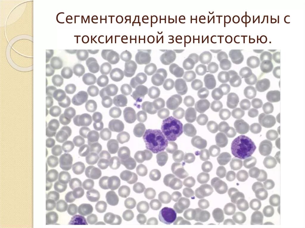 Сегмента ядерная. Токсогенная зернистость нейтрофилов. Токсикогенная зернистость нейтрофилов. Зернистость сегментоядерных нейтрофилов. Токсигенная зернистость нейтрофилов.