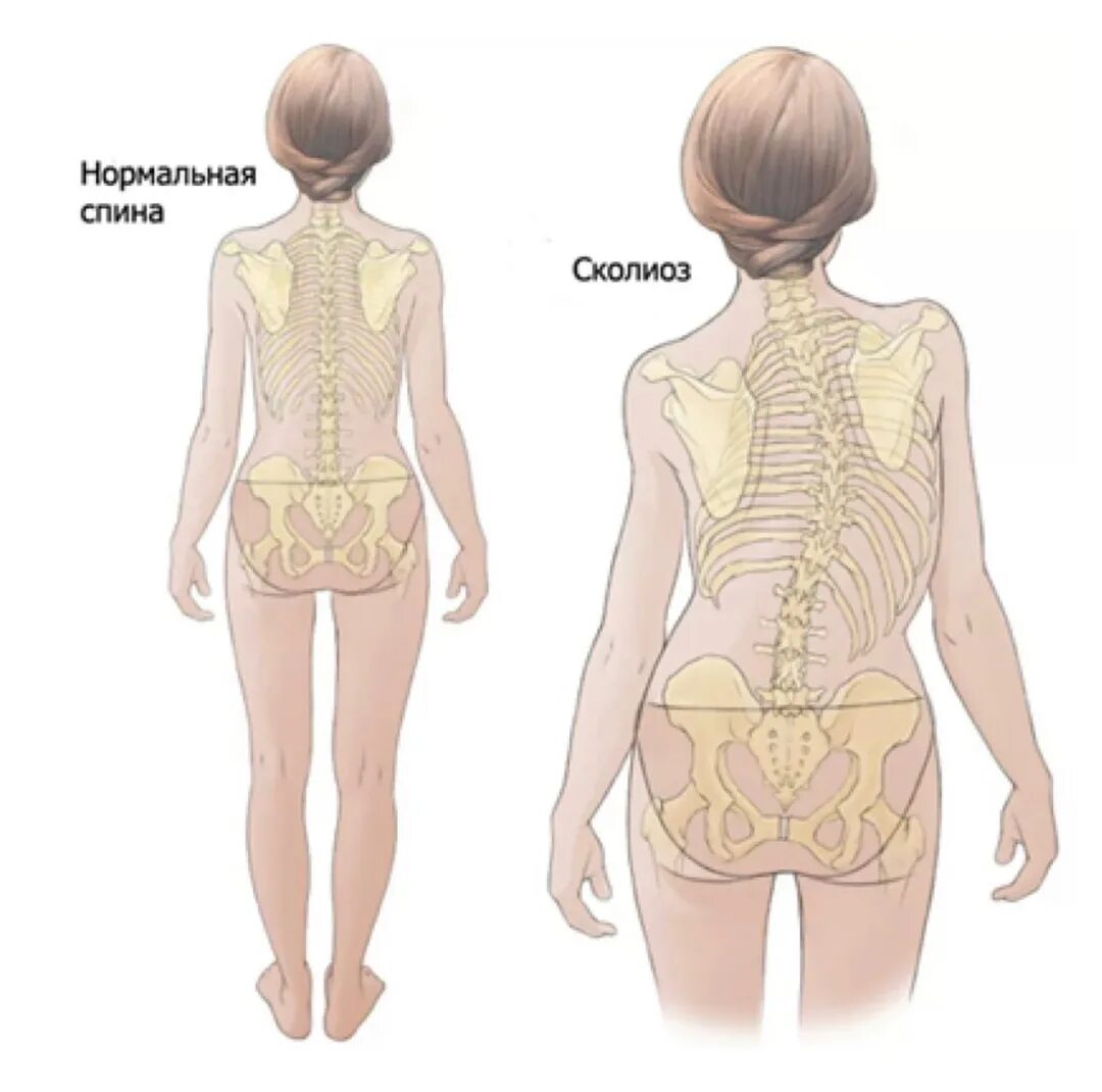 сутулая спина. нормальная спина ребенка. нормальная спина ребенка. правильная осанка у детей дошкольного возраста. искривление позвоночника у детей.