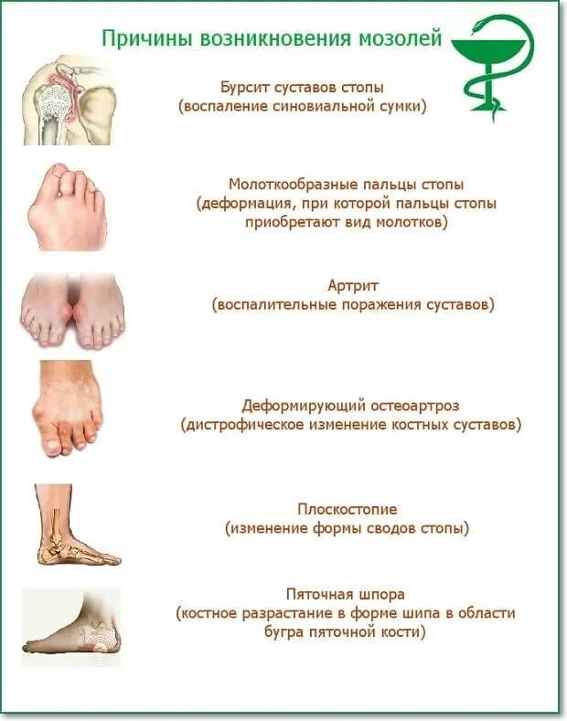 Шпоры причина появления. Сухая мозоль сбоку стопы. Стержневая мозоль на стопе.