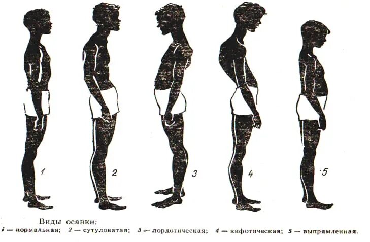 Как называется нормальный человек. Нарушение осанки лордоз. типы осанки человека лордоз. сутулая осанка выпрямленная осанка сколиотическая осанка. лордотическая осанка у человека.