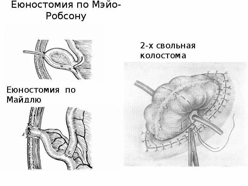 Лапаротомия еюностомия. Еюностомия по Эйзельсбергу. Еюностомия по Мейо-Робсона. Операция желудка кишечника