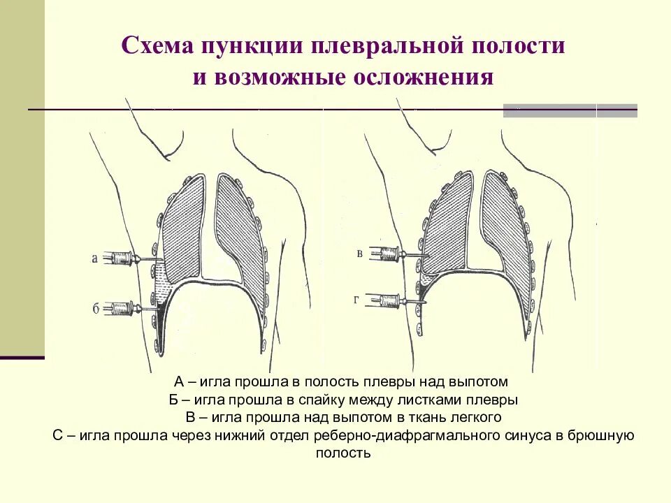 Пункция плевральной полости схема. Точки пункции плевральной полости. Методика пункции плевральной полости. Пункция и дренирование плевральной полости показания техника. Осложнения после пункции