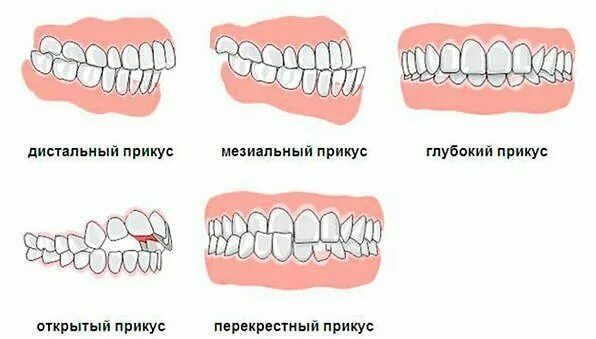 BRACES FOR OVERBITE AND UNDERBITE Dental hygiene school, Dental assistant study,