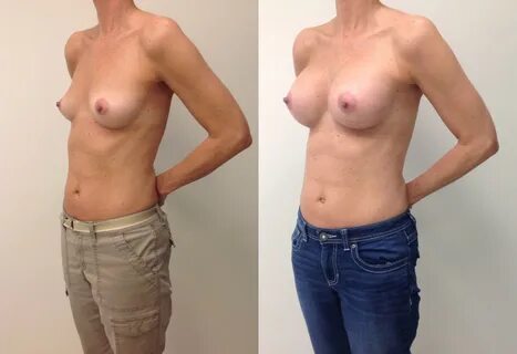 Breast implants nude.