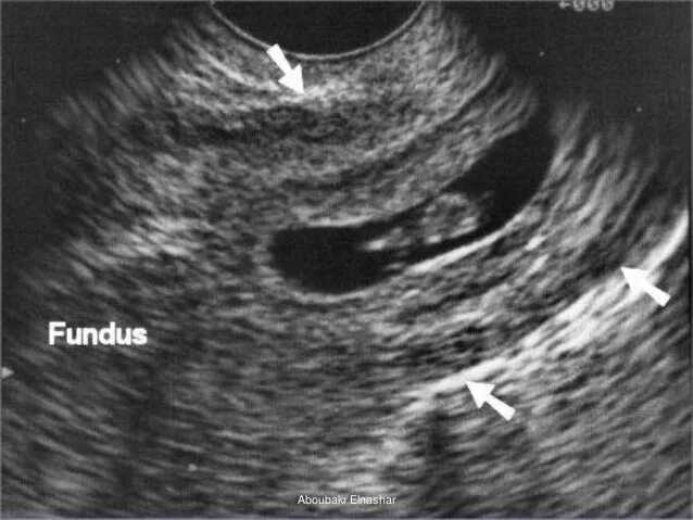 Внематочная беременность на УЗИ. Внематочная беременность на УЗИ фото. УЗИ внематочной беременности 5 недель. На узи видно внематочную