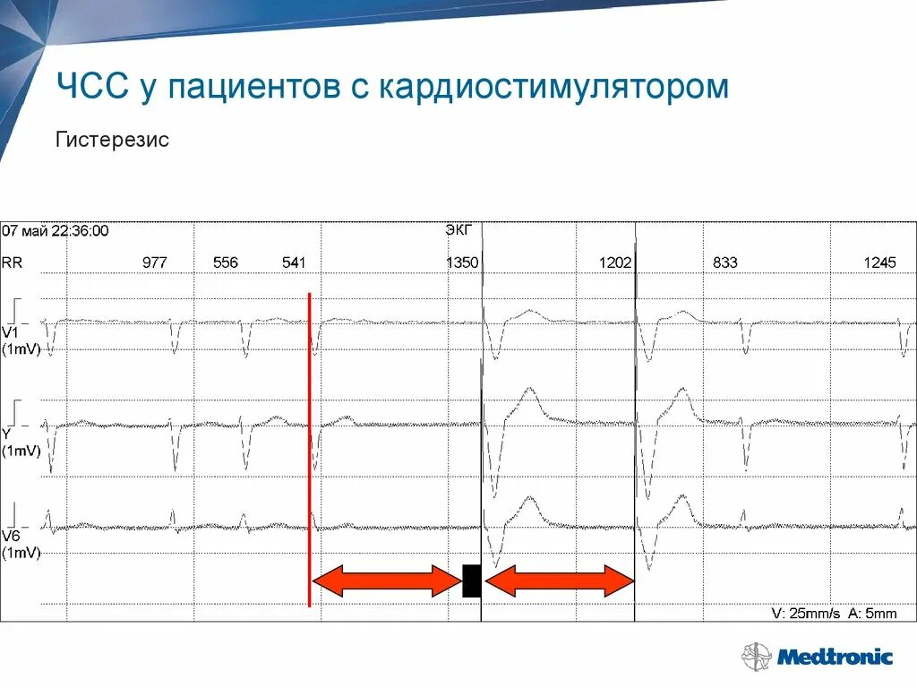 Кардиостимулятор при каком пульсе. Частота кардиостимулятора. карточка кардиостимулятора. частота сердцебиения водителя ритма. введение пациентов с кардиостимулятором.