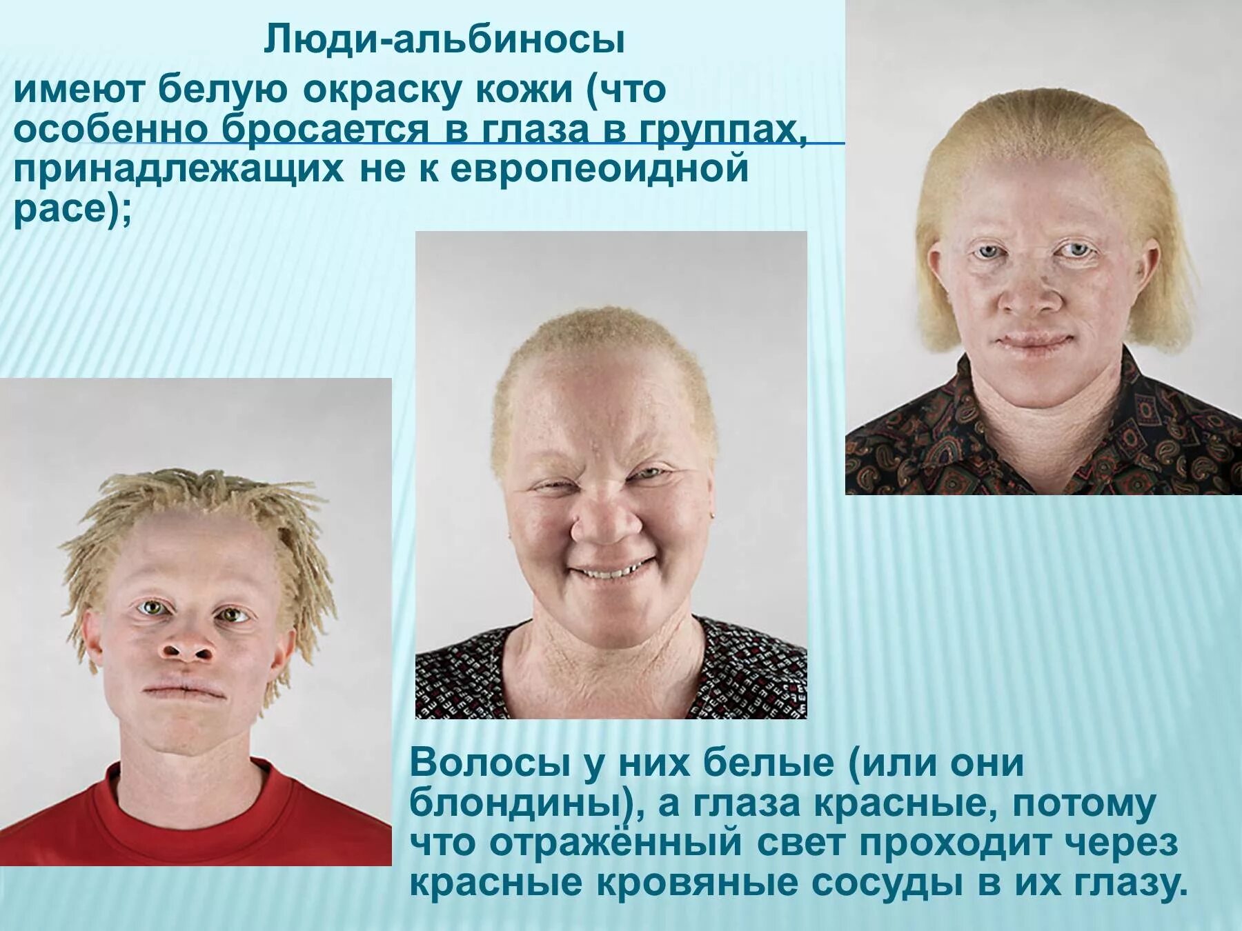 Появление в потомстве альбиноса. Альбинизм 1в. Альбинизм хромосомная мутация. Альбинизм: болезнь альбиносов. Альбиносы люди фото.