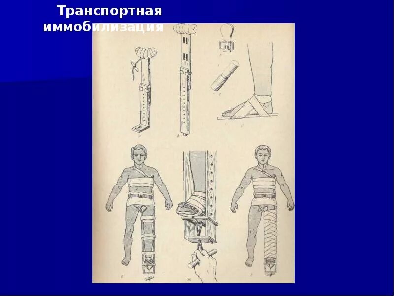 Тесты транспортная иммобилизация. Иммобилизация при переломе костей голени. Лестничная шина крамера. Транспортная иммобилизация. Шина крамера при переломе костей голени.