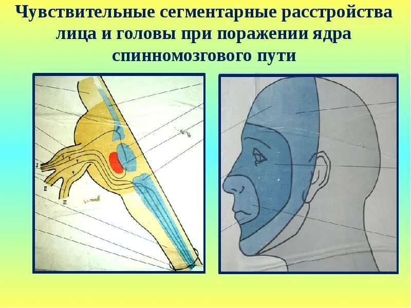 Сегментарный тип расстройства. Зоны зельдера. зоны зельдера тройничного нерва. сегментарная чувствительность лица. типы нарушения чувствительности на лице.
