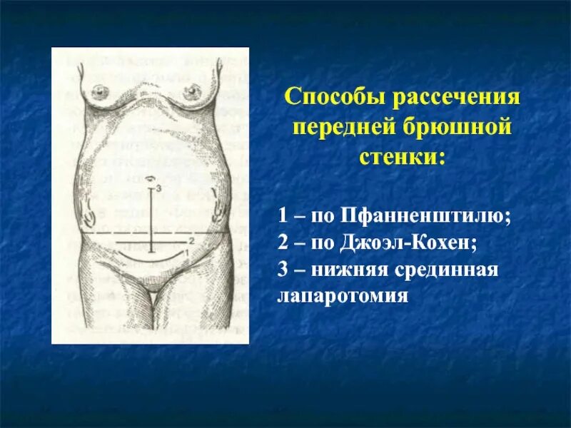 Нижняя срединная лапаротомия по Пфанненштилю. Пфанненштилю кесарево сечение. Лапаротомия Пфанненштилю кесарево. Техника кесарева сечения